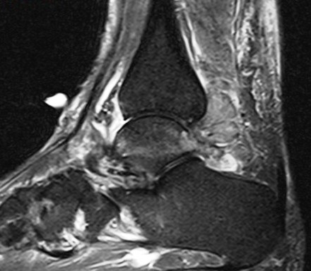 Figure 5 for case Gout arthritis ( RID3567 )